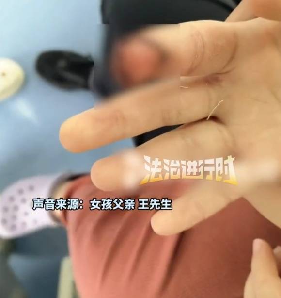 皇冠信用網申请_北京7岁女童喂马时被咬伤手指指甲断裂皇冠信用網申请，度假区致歉：先行支付10万元